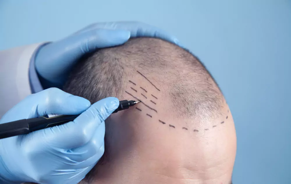 Sapphire Technique Hair Transplant